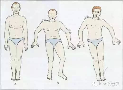 rombergs测试时无方向性来回摇晃-站立不稳下蚓部损害-跟膝胫试验
