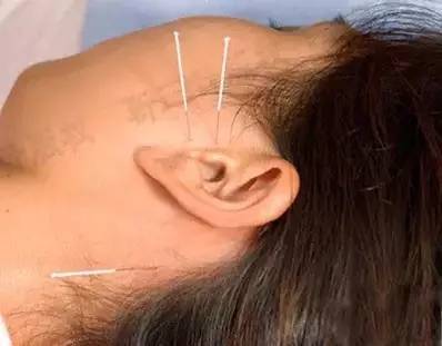 图解"针灸三针30组穴位"