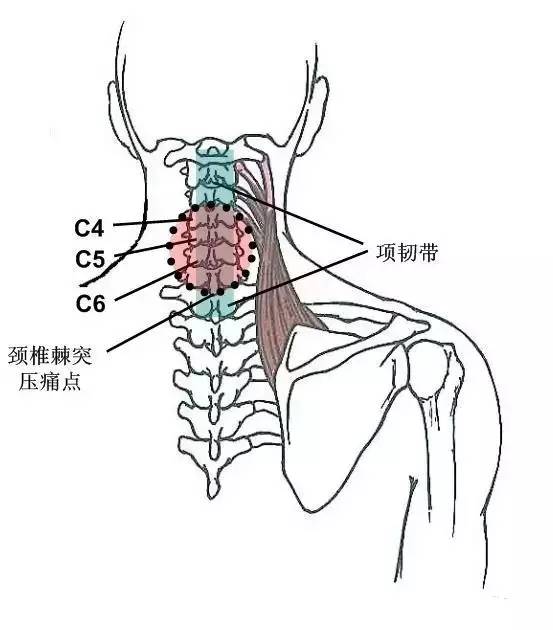 颈椎横突的定位图图片