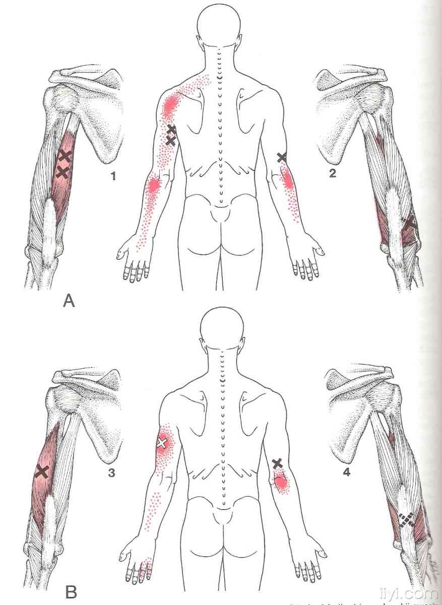 肌筋膜触发点的图解