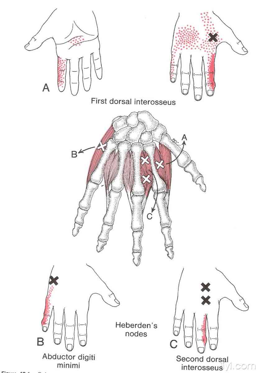 肌筋膜触发点的图解