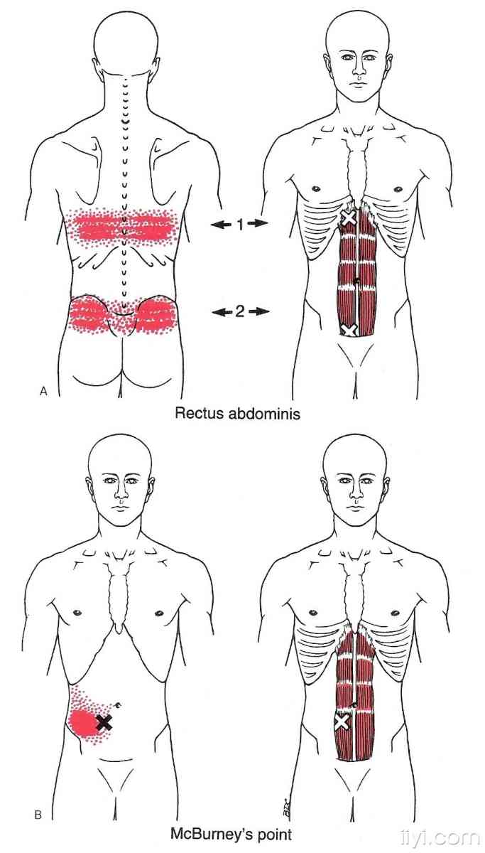 肌筋膜触发点的图解