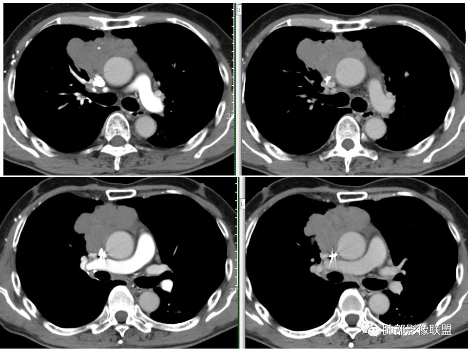 【每日晨读】 快速判断胸腺瘤