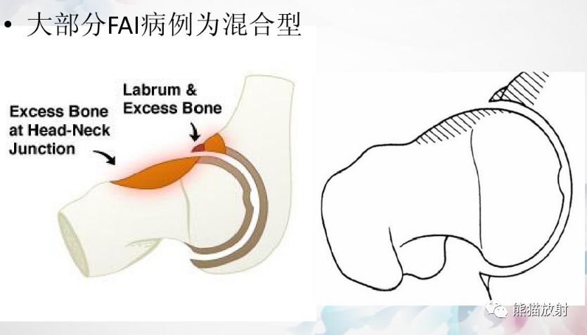 髋关节撞击综合征（fai）丨影像表现