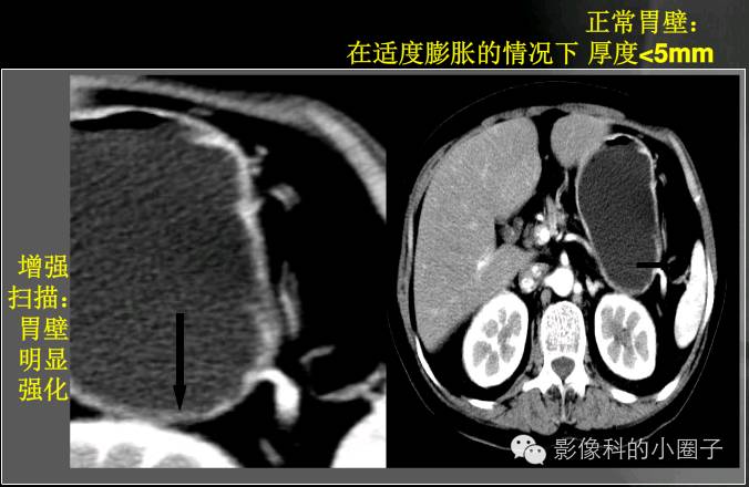 编者注:消化道ct检查重点是要解决消化道管壁显影,在空腔脏器的容积