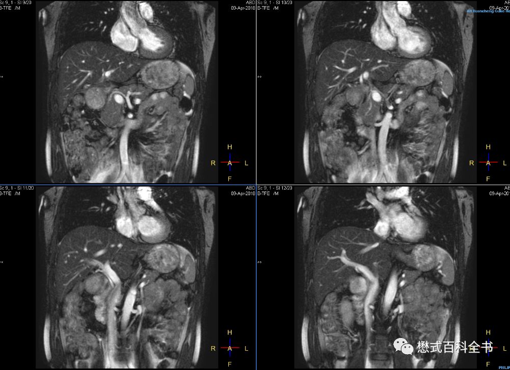 磁共振参数的故事(十)——如何做好腹部balance序列