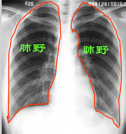 肺(肺野,肺纹理,肺门)认识肋骨是看胸片的基础,肺部病变常常以肋骨