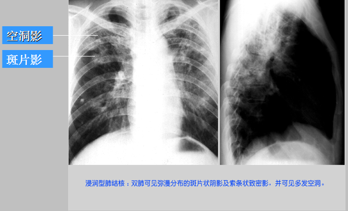 位於肺尖的滲出性病變多為結核,而肺底部則常為肺炎.