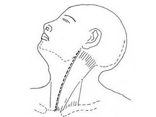 百家解读胸锁乳突肌