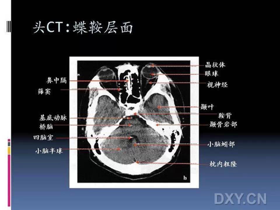 侧脑室三角区CT解剖图图片