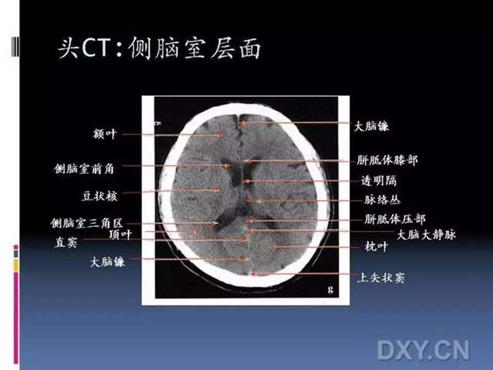 颅脑CT层面分层图片