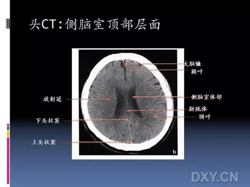 10张图搞定正常头颅ct断层解剖