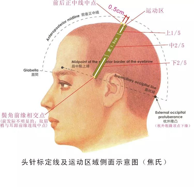 焦氏头针疗法定位图图片