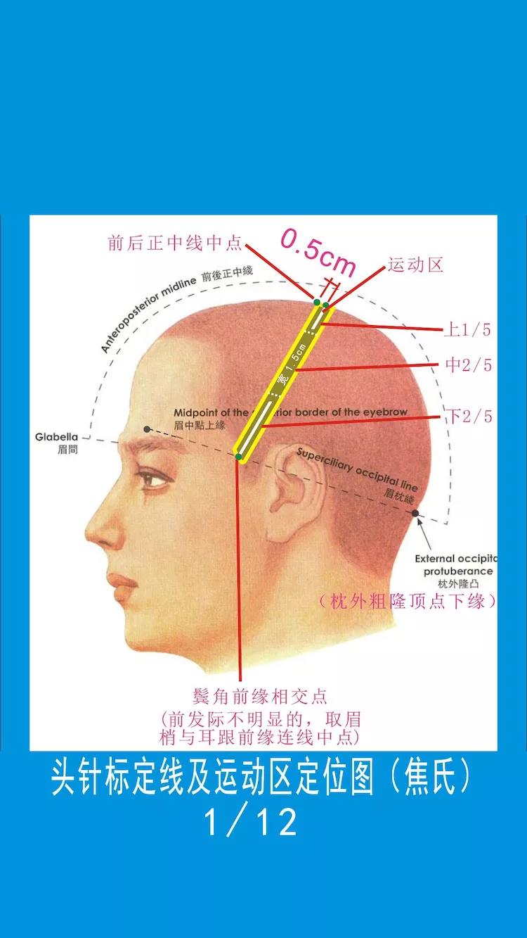 头皮针言语一区位置图图片