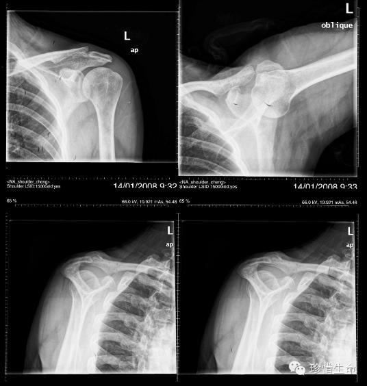 x线肩关节穿胸位图片