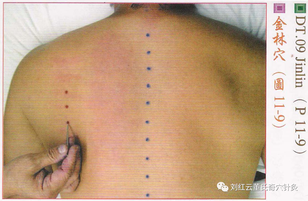 董氏奇穴十一部分后背部穴位详解收藏版带高清大图