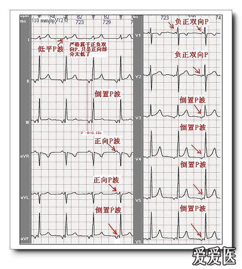 山羊老师课程常见心电图基础知识讲座第四讲p波方向来源分析