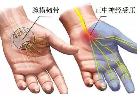 腕管综合症解剖图图片